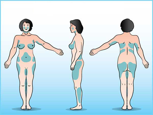 les zones du corps traitées par la liposuccion