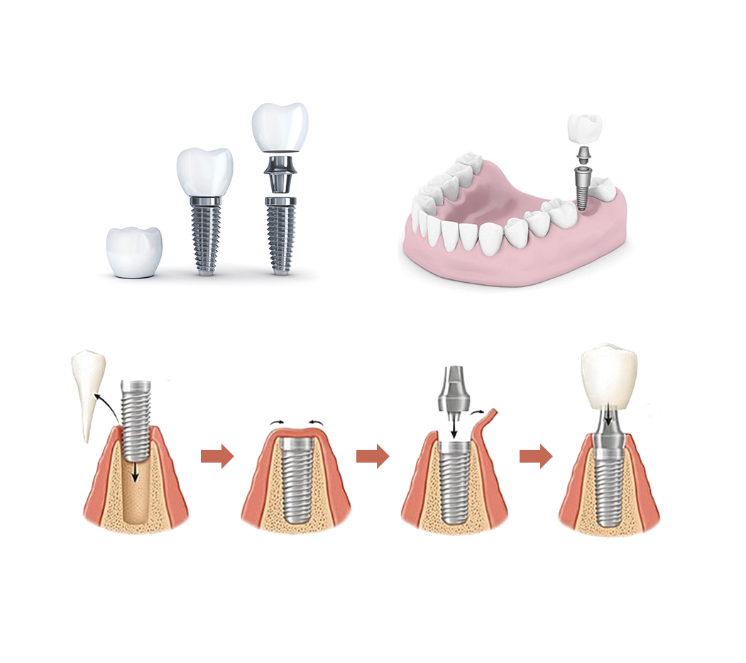 implants-dentaire-détails-1
